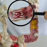 Doenças inflamatórias intestinais crescem cinco vezes no Brasil em 13 anos